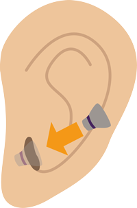 Infografik Hörgerät In-Ear-Variante